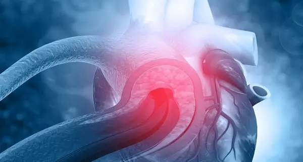 Disecția aortică: o urgență medicală serioasă