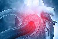 Disecția aortică: o urgență medicală serioasă